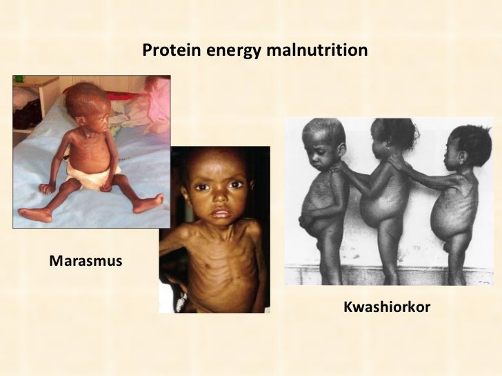 protein calorie deficiency diseases all articles about protein energy malnutrition
