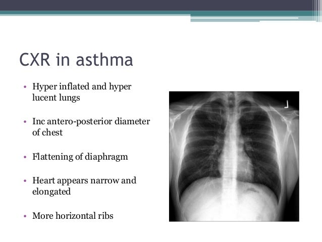chest x ray pa view asthma