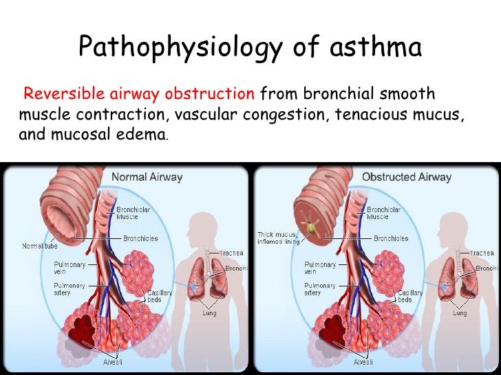 Asthma in pregnancy