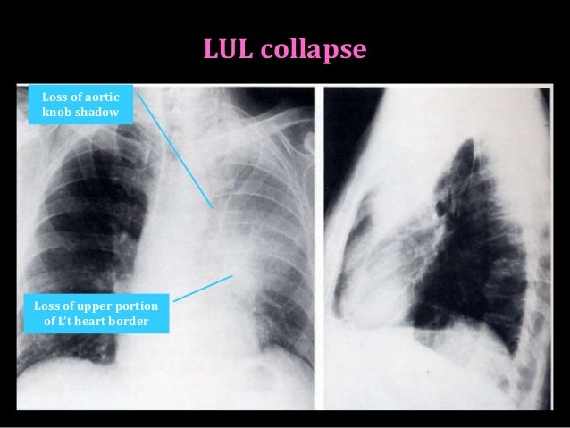Atelectasis and collapse in CXR