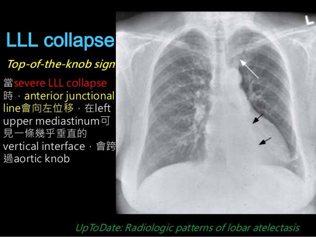 Pleural Thickening Left Lung Base