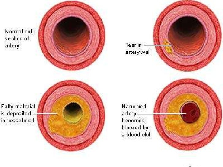 Atherosclerosis