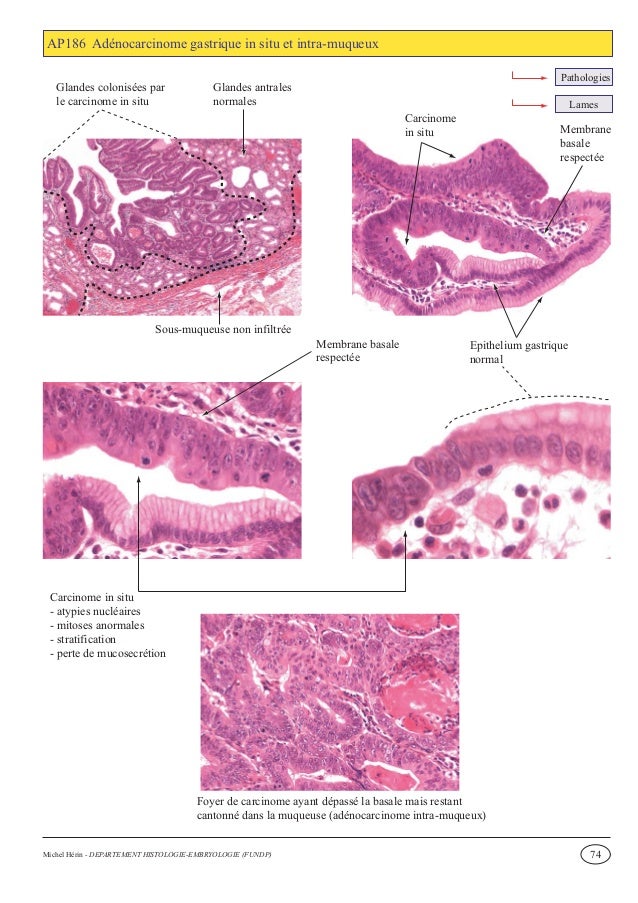Tumeur Neuroendocrine
