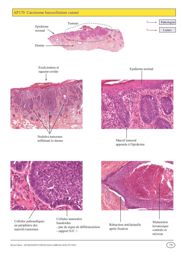 oncologie klina wo okayönnen melanome auftreten