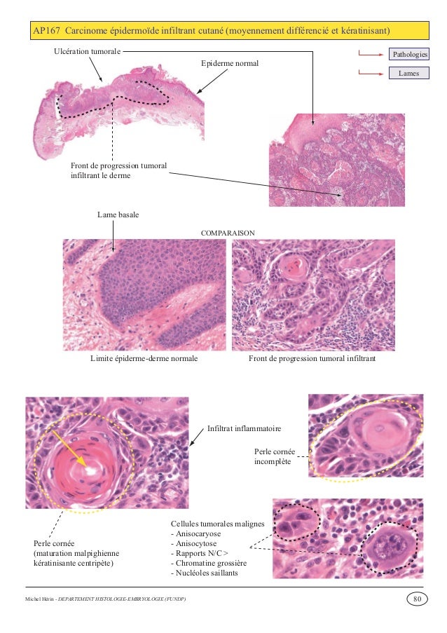 Lymphome jeune homme chimiothérapie effets secondaires os
