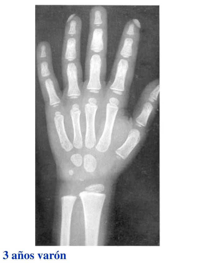 Atlas greulich y pyle