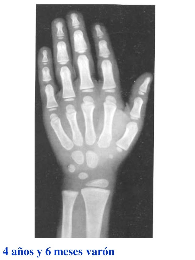 Atlas greulich y pyle