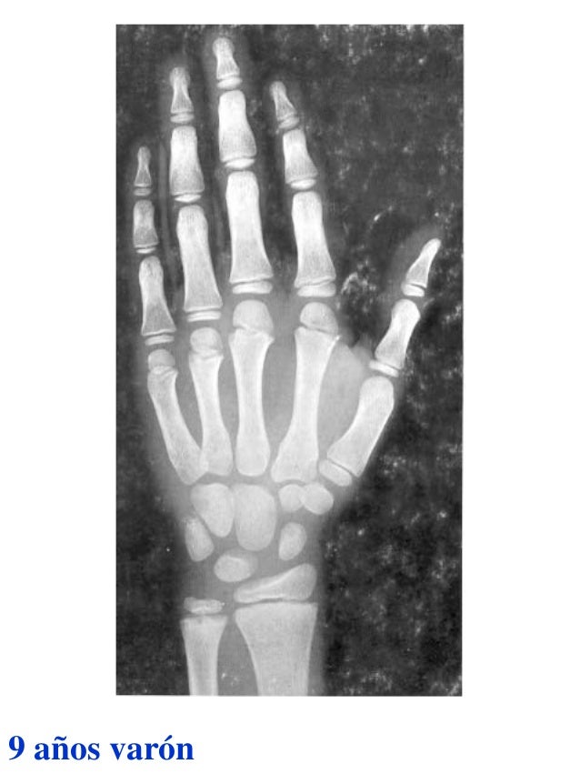 Atlas greulich y pyle