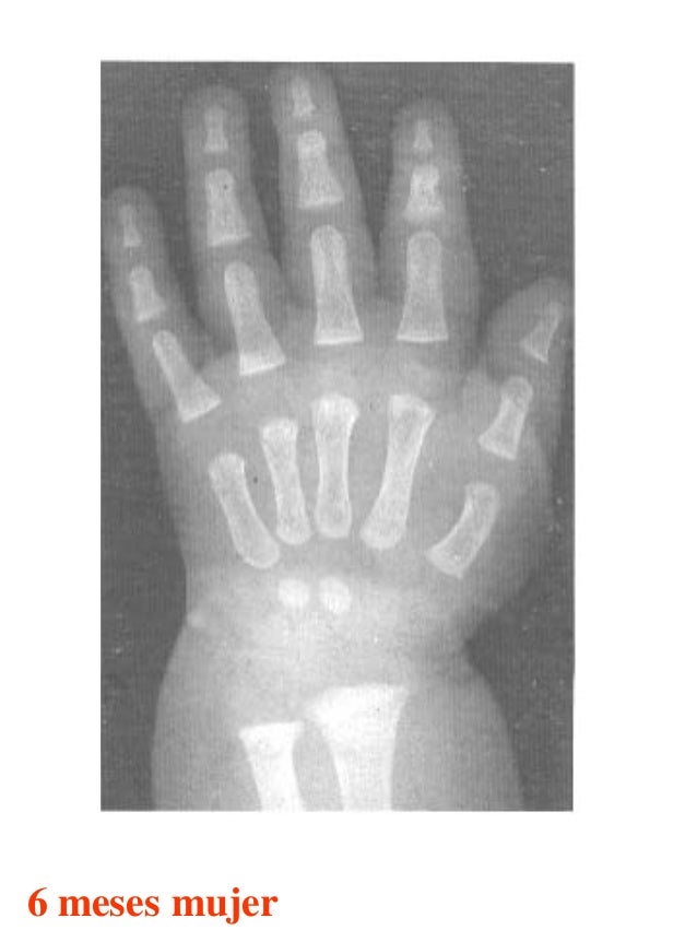 Atlas greulich y pyle