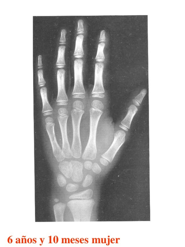 Atlas greulich y pyle