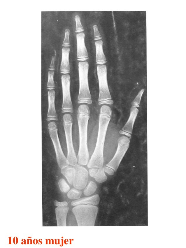 Atlas greulich y pyle