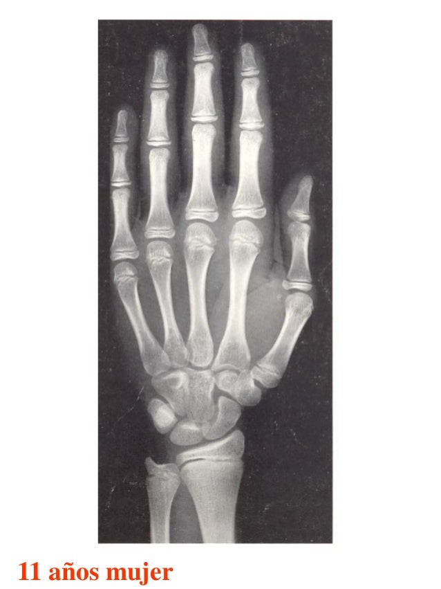 Atlas greulich y pyle