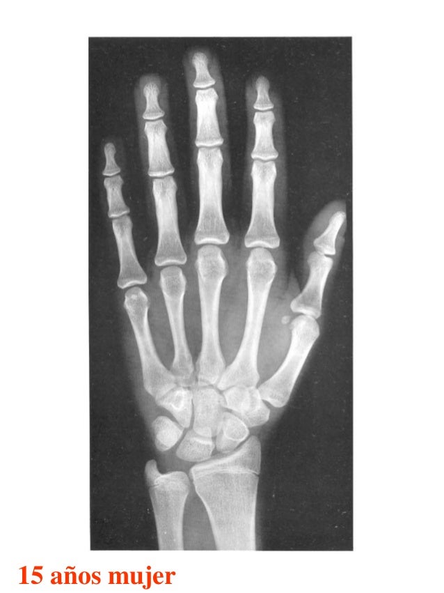 Atlas greulich y pyle