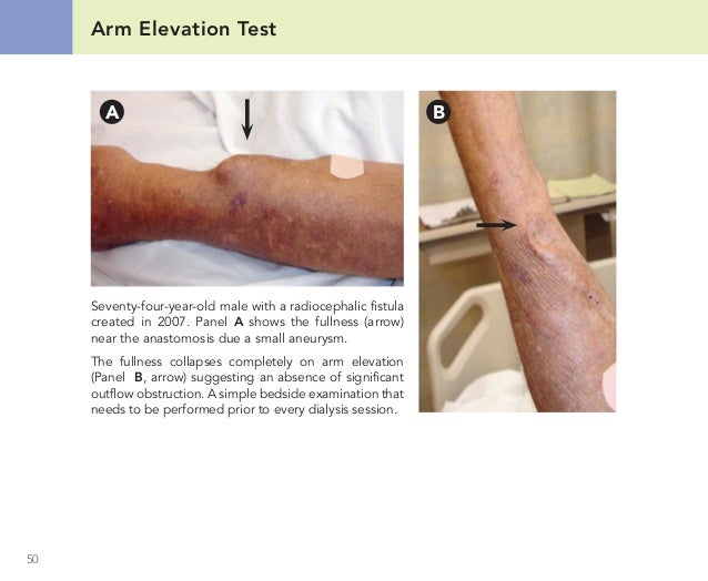 Hemodialysis middle within the philippines dialysis system hydraulics