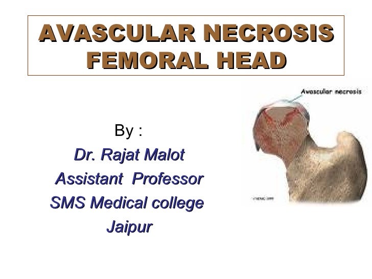 Avascular Necrosis Femoral Head By Dr Rajat Malot Msdnbfellowship