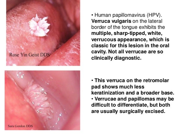 papilloma in mouth #10