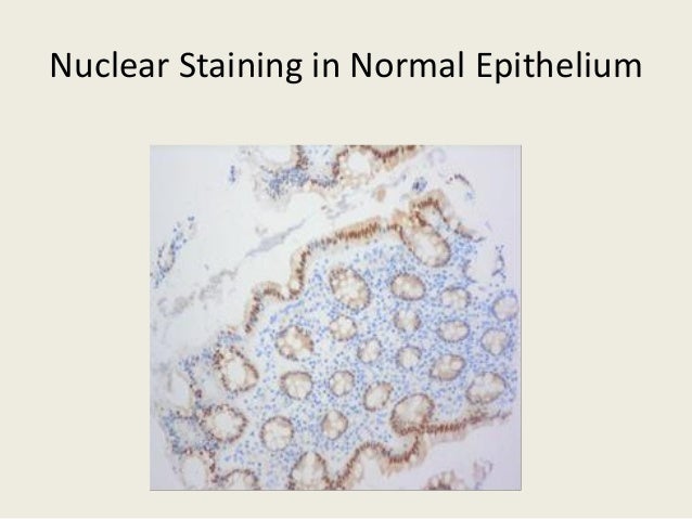 Sarcomatoid Mesothelioma Immunohistochemistry