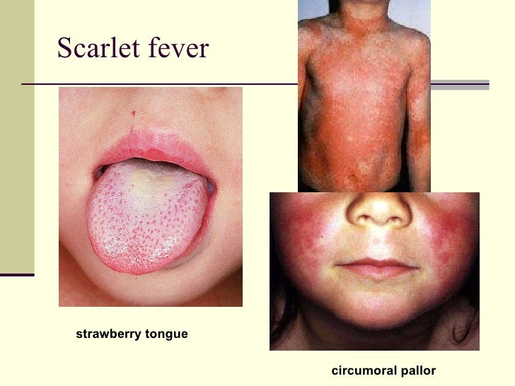 Symptoms & Treatment | Typhoid Fever | CDC