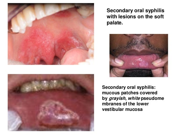 Quitting Smoking Causes Mouth Ulcers