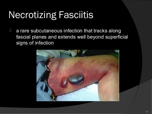the characteristics of necrotizing fasciitis a rare illness Late diagnosed necrotizing fasciitis as a cause of multiorgan dysfunction syndrome: mainly as indices of illness severity and for outcome prediction supple k, gamelli r: the evolving characteristics and care of necrotizing soft-tissue infections burns 2005, 31. the characteristics of necrotizing fasciitis a rare illness Late diagnosed necrotizing fasciitis as a cause of multiorgan dysfunction syndrome: mainly as indices of illness severity and for outcome prediction supple k, gamelli r: the evolving characteristics and care of necrotizing soft-tissue infections burns 2005, 31.
