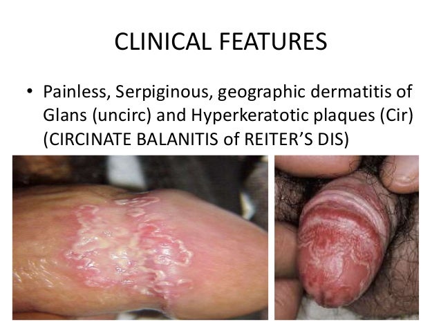 Angular Cheilitis - Pictures, Symptoms, Contagious, Treatment