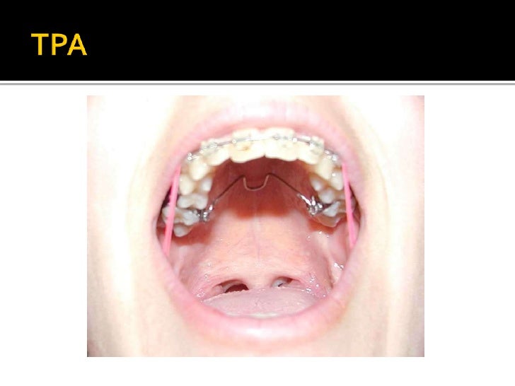barra transpalatina superior barra transpalatina drs barra transpalatina superior barra transpalatina drs