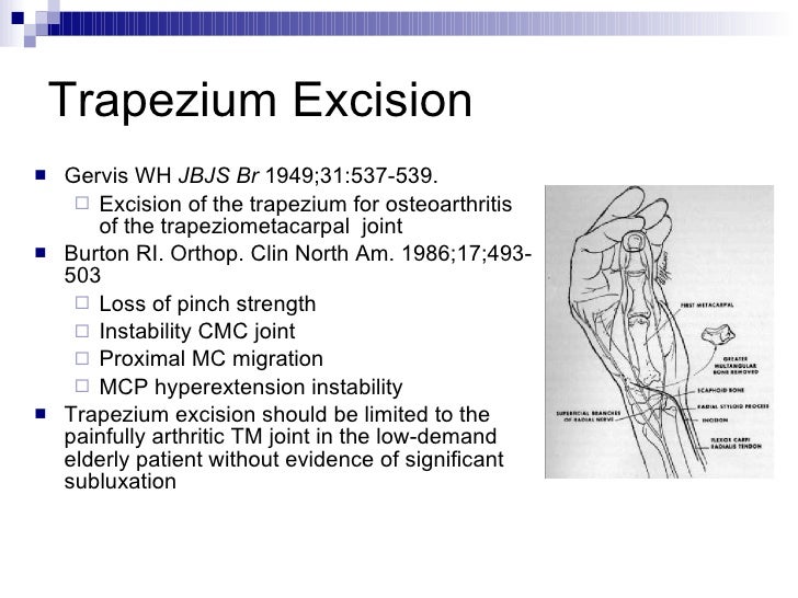 Basal Joint Arthritis Of The Thumb