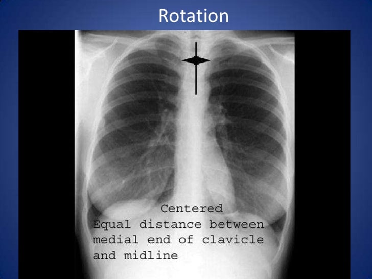 Basic interpretation of cxr