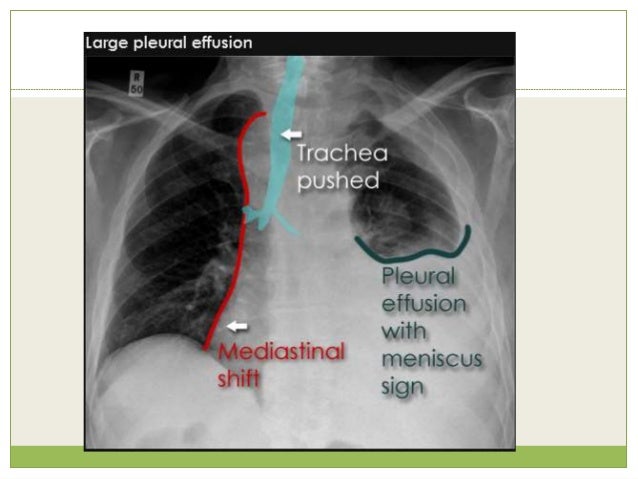 Pleural Thickening Treatment