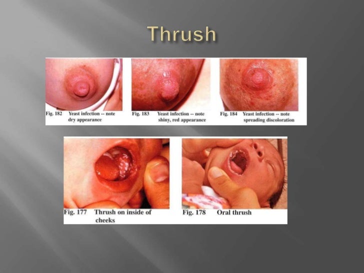 Thrush Nipples Picture 39
