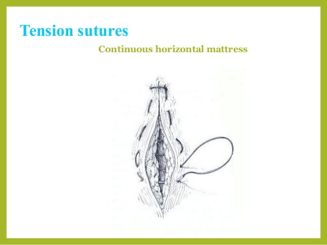suture patterns