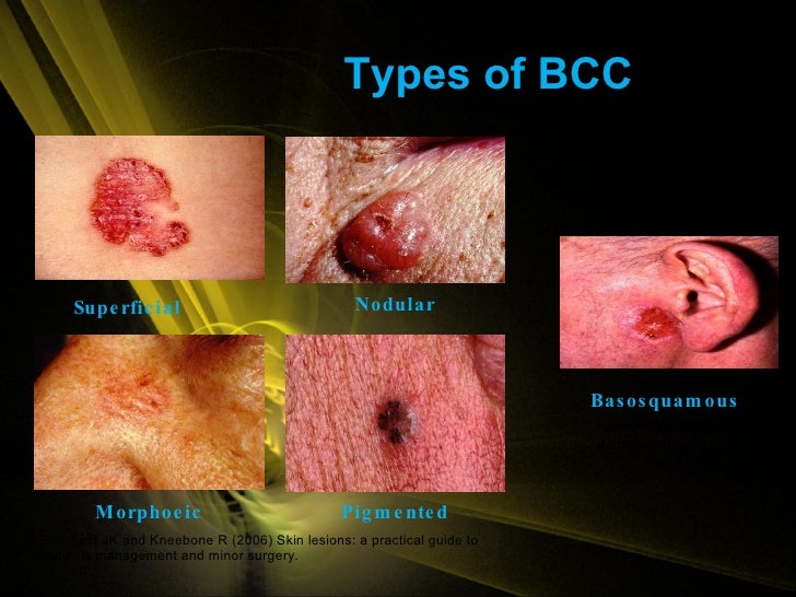 Basal Cell Carcinoma (BCC) - SkinCancer.org