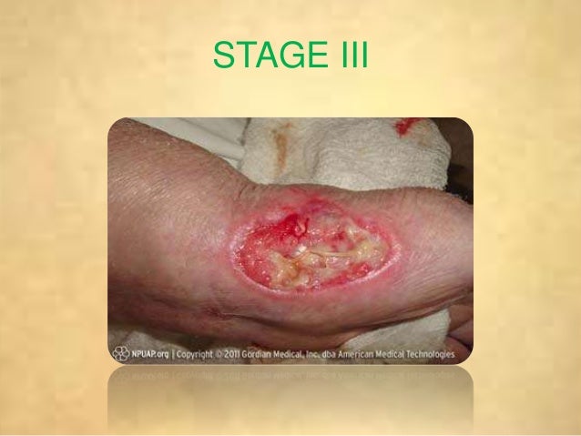 stage iii pressure ulcer stage iii pressure ulcer