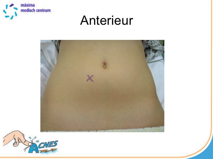 acnes operatie