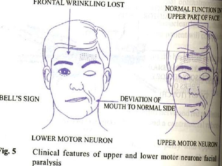 Facial nerve upper motor - Pics and galleries New porn Amateur girlfriend clip