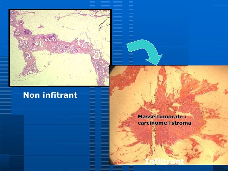 Carcinome Mammaire Infiltrant