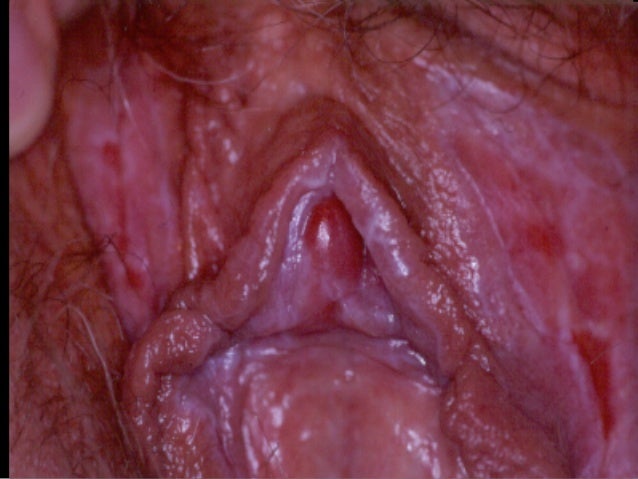 lichen planus vulva