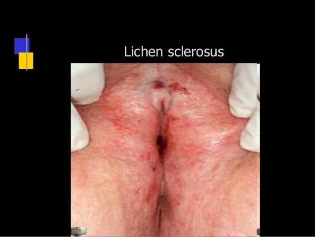 NHG-Standaard Lichen sclerosus | NHG