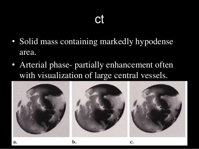 Benign focal lesions in liver