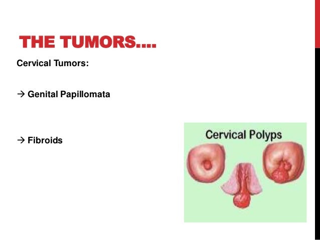 Natural Cure For Fibroids In Nigeria Natural Cure For Fibroids In Nigeria