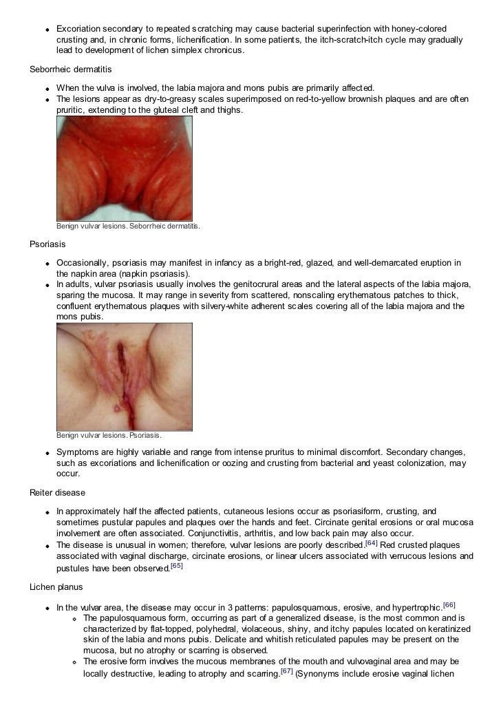 Itchy Labia minora - Women's Health - MedHelp