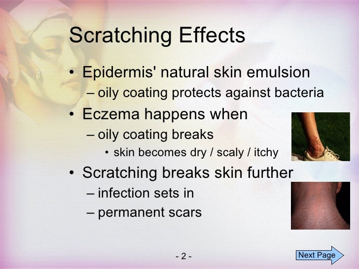 Best Natural Remedy For Atopic Eczema Best Natural Remedy For Atopic Eczema