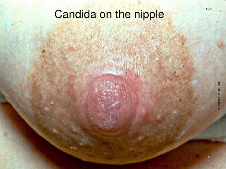 Paget's disease of the nipple - Diagnosis - NHS Choices