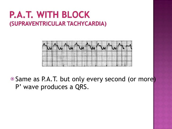 ECG Multifocal Atrial Tachycardia