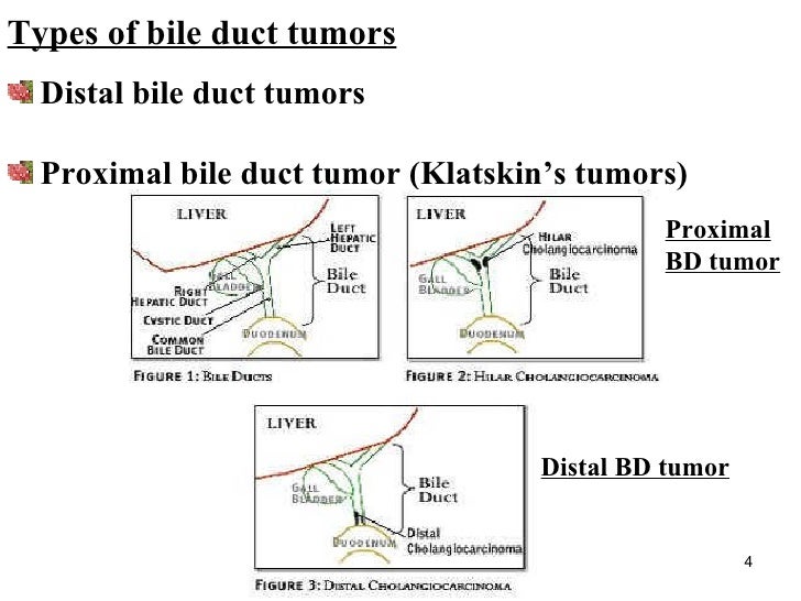 Number one Liver most cancers