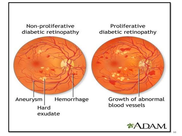 Biomarkers of diabetic retinopathy