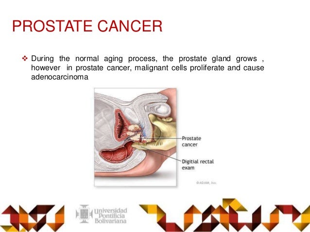 doxazosin prostate cancer