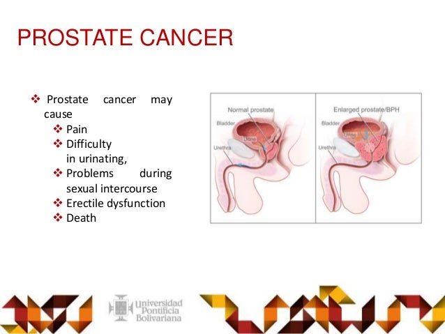 doxazosin prostate cancer