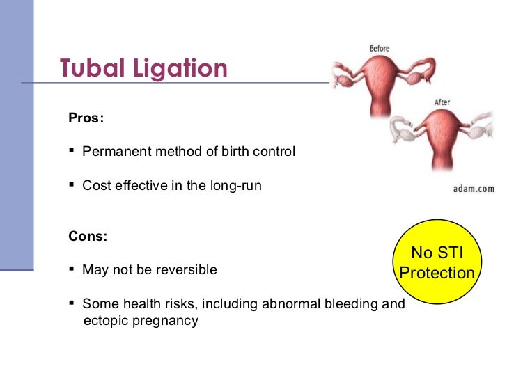 Birth Control Methods