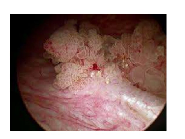 Neoadjuvant Chemotherapy - RxMxAx Dead Cannibal - Torture Time Neoadjuvant Chemotherapy - RxMxAx Dead Cannibal - Torture Time